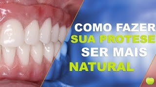 Como Fazer a Prótese com Implantes parecer Natural [upl. by Aroda]