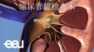 输尿管镜手术 Ureteroscopy  URS [upl. by Yecrad]