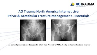 Open Reduction Internal Fixation of Patella [upl. by Oidgime799]