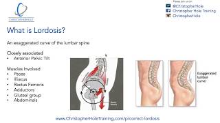 Lordosis Treatment A 3 Step Process [upl. by Molini]