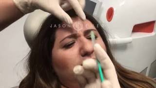 Botox to Glabellar quot11quot Lines  Allergan Neurotoxins  Forehead Eyebrow Wrinkles  Beverly Hills [upl. by Romelle193]