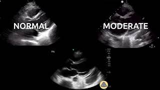 Evaluating for Reduced Ejection Fraction PSLA [upl. by Aenat]