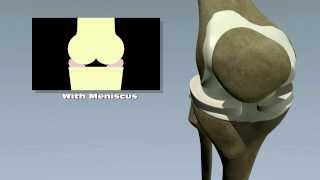 Meniscus Tears [upl. by Hong]