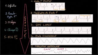 Hyperkaliémie  PseudoHyperK  Clinique ECG  Étiologies  Traitement  Docteur Synapse [upl. by Barb]