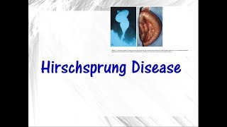 Hirschsprung disease [upl. by Butch]