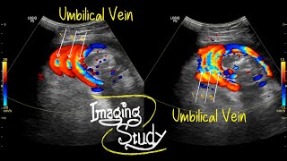 Three Layers of Umbilical Cord around the Fetal Neck  Ultrasound  Doppler  Case 36 [upl. by Nivle]