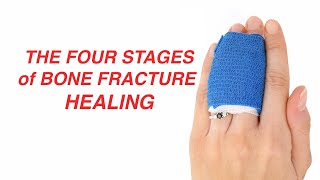 The Four Stages of Bone Fracture Healing [upl. by Hester]