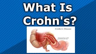 What is Crohns Disease [upl. by Vieva]