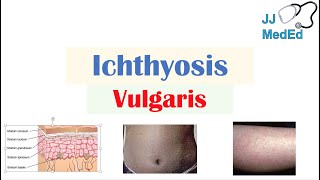 Ichthyosis Vulgaris  Causes Signs amp Symptoms Diagnosis Treatment [upl. by Koehler]