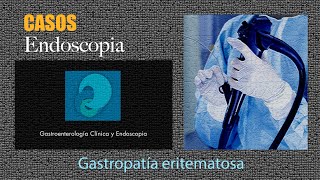 Gastropatía eritematosa [upl. by Chema38]