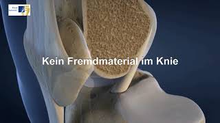 Knie OP bei Kreuzbandriss  3DAnimation Kniegelenk [upl. by Nirro2]