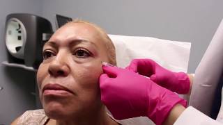 Botox for the Glabella Crows Feet and Forehead [upl. by Guinevere31]