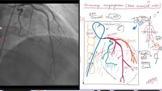 Coronary Angiogram RAO cranial view [upl. by Raama]