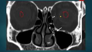 OSTEOMEATAL COMPLEX UNIT OMC ON CT ANATOMY SIMPLIFIED [upl. by Seltzer]