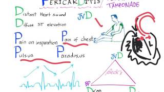 Pericarditis Tamponade physical findings [upl. by Aibat103]