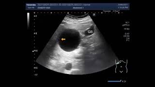 Hepatic Hydatid Cyst Two cases [upl. by Stallworth254]