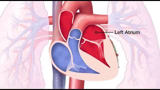 Mitral Stenosis Heart Sound  MEDZCOOOL [upl. by Nahtanoj]