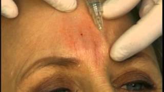 Dr Elliott Shows How to Fill Frown Glabella Lines With A Dermal Filler [upl. by Aicilet]