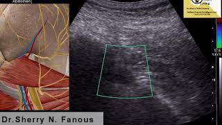 Piriformis Scan using Ultrasound [upl. by Barvick]