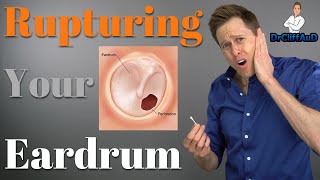 Hidden Earlobe Cyst  Dr Derm [upl. by Rutger]