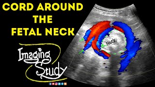 Umbilical Cord Around The Fetal Neck  Ultrasound  Doppler  Case 46 [upl. by Lissak248]