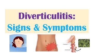 Diverticulitis Signs amp Symptoms And Why They Occur [upl. by Ainad890]