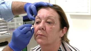 Injecting Botox into the Glabella region  Training Video For Medical Professionals Only [upl. by Odell]