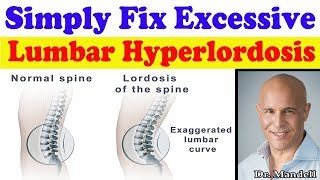 Simply Fix Excessive Lumbar Hyperlordosis  Dr Alan Mandell DC [upl. by Forland]