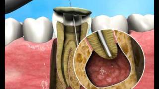 Treatment of Apical Periodontitis  a new approach [upl. by Fedora]