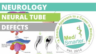 USMLE Step 1  Neurology Neural Tube Defects [upl. by Riti242]