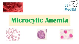 Microcytic Anemia amp Causes Iron Deficiency Thalassemia Anemia of Chronic Disease Lead Poisoning [upl. by Kori]