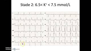 Hyperkaliémie signes ECG [upl. by Gaelan455]