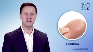 Understand and Manage Wart amp Verruca [upl. by Ydnor]