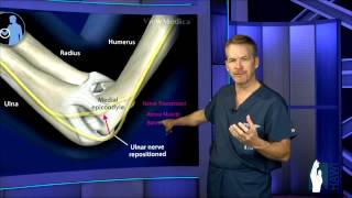 Cubital Tunnel Surgery [upl. by Schurman]