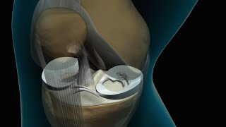 Torn Knee Meniscus Repair [upl. by Reina]