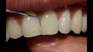 Dental Flossing Technique [upl. by Kay]