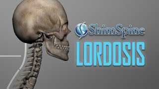 Lordosis [upl. by Anesuza]