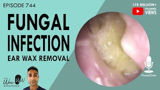 How do Kids get Ear Infections [upl. by Rowell874]