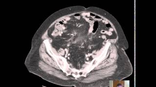 CT Sigmoid Diverticulitis DISCUSSION [upl. by Anila876]