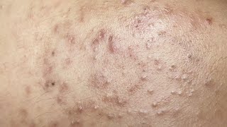 Blackhead Removal For Puberty  Loại Bỏ Mụn Đầu Đen Ở Tuổi Dậy Thì  SacDepSpa303 [upl. by Ahsieken384]